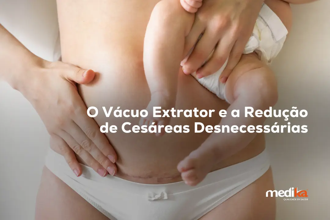 O Vácuo Extrator e a Redução de Cesáreas Desnecessárias